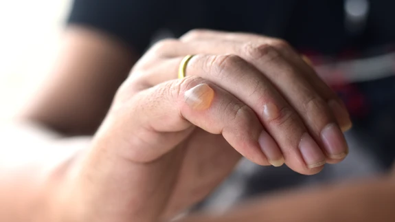 Põletuskoha jahutamisel ei tohi mingil juhul kasutada jääd, sest see suurendab koekahjustuse tekkimise võimalust.