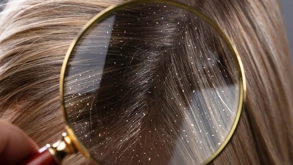 Kõõma on eri kujul, see võib olla nahal plaatidena, õhukeste või paksude, kuivade või rasvaste laikudena.